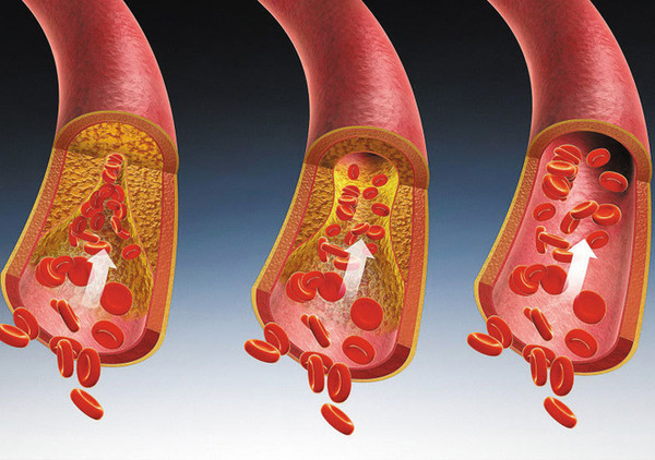 Cardiovascular and Cerebrovascular Disease
